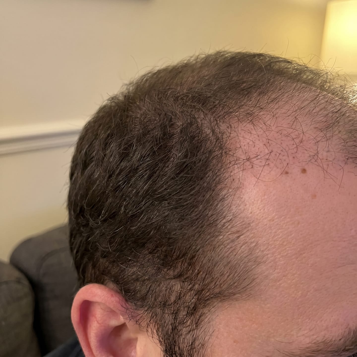 Customer photo review of RootFix - ערכה לטיפול בנשירה והתקרחות של השיער