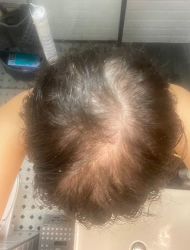 Customer photo review of Hair Loss Prevention Kit