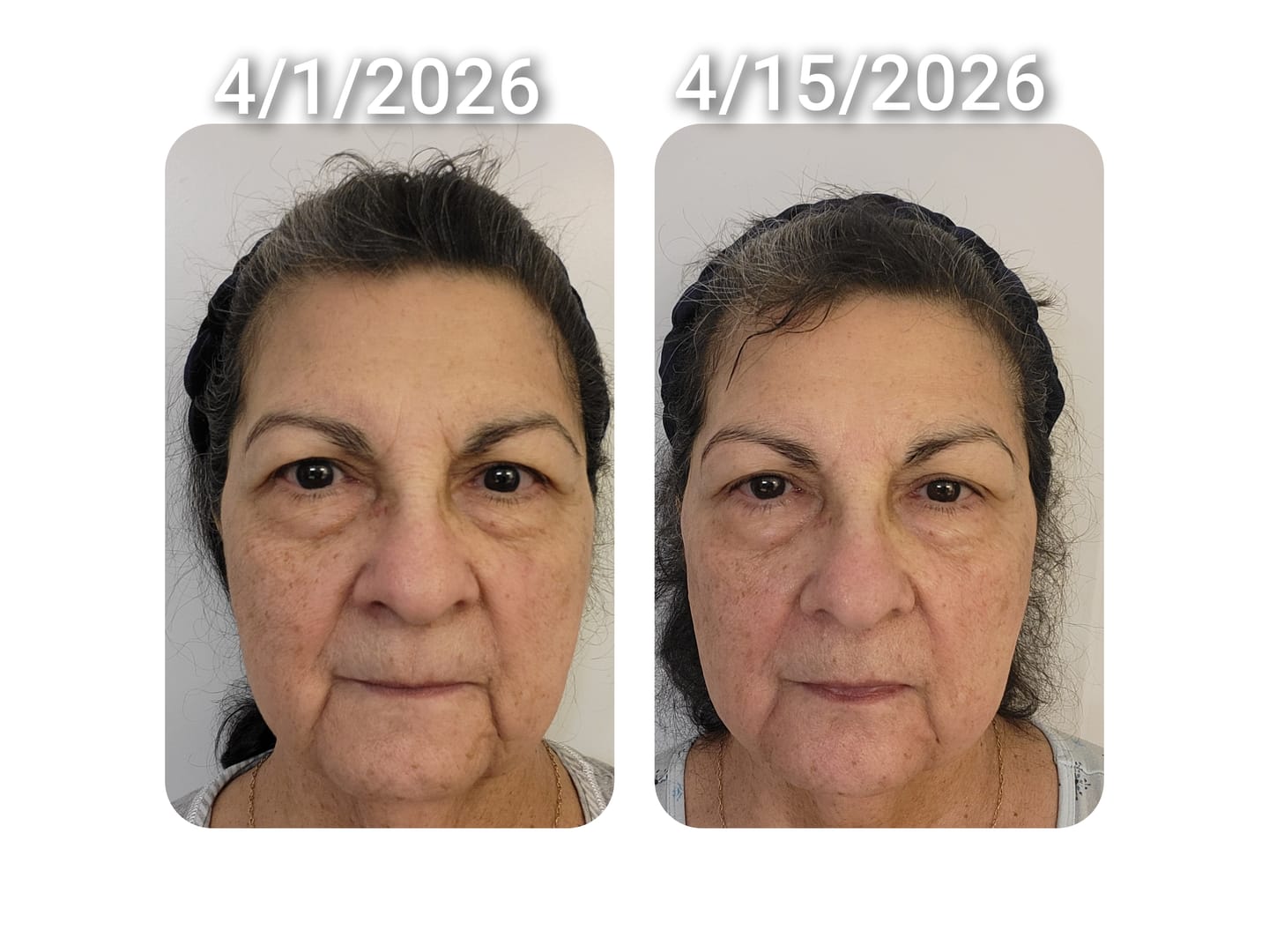 Customer photo review of 1 Month Supply - Micro Infusion Patches