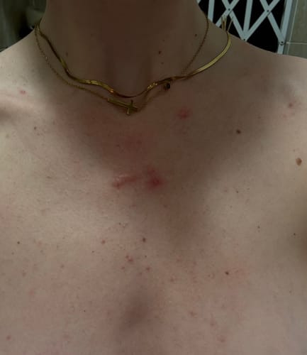 Customer photo review of Bumps Be Gone