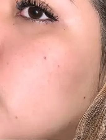 Customer photo review of AZELAIC ACID 10 HYALURON REDNESS SOOTHING SERUM