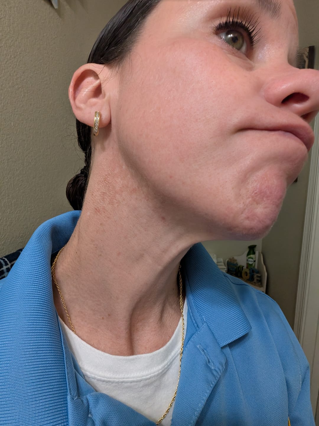 Customer photo review of Scrub for Acne Prone Skin