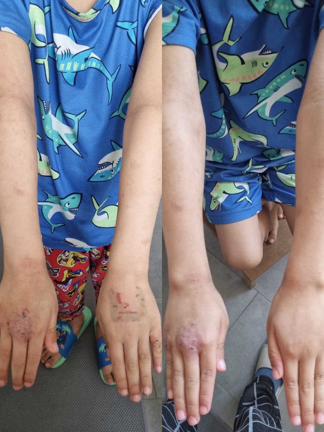Customer photo review of Eczema Scratch Mitten