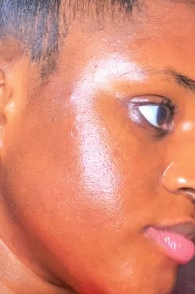 Customer photo review of AZELAIC ACID 10 HYALURON REDNESS SOOTHING SERUM