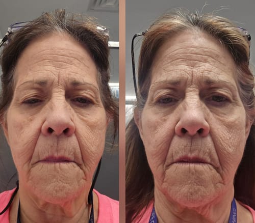 Customer photo review of 3 Month Supply - Seranova Micro Infusion System