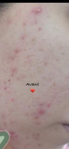 Customer photo review of CLARIFYING SERUM