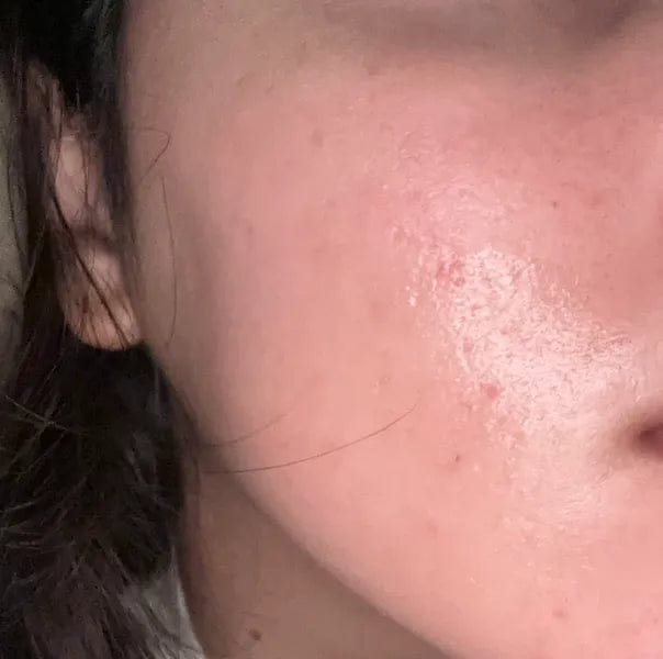 Customer photo review of AZELAIC ACID 10 HYALURON REDNESS SOOTHING SERUM