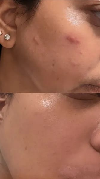 Customer photo review of AZELAIC ACID 10 HYALURON REDNESS SOOTHING SERUM