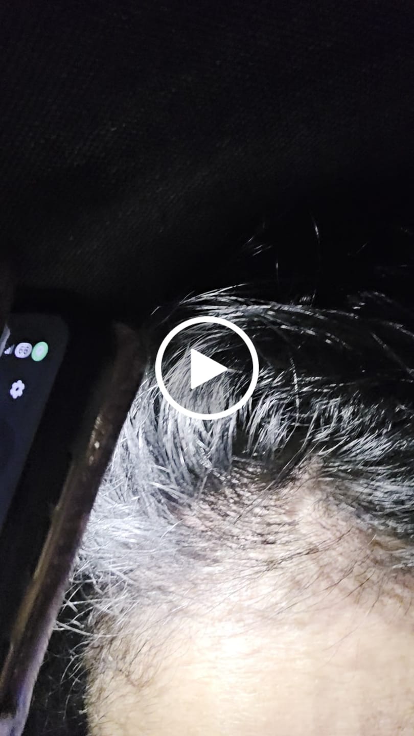 Customer video review of Glov Micro Infusion System