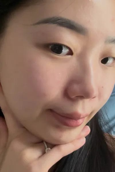 Customer photo review of AZELAIC ACID 10 HYALURON REDNESS SOOTHING SERUM