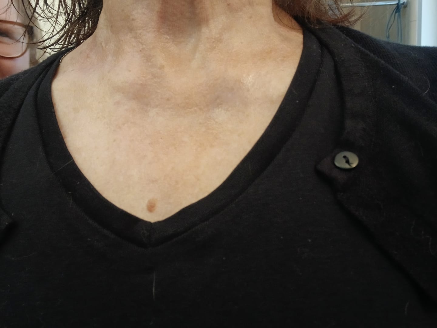 Customer photo review of Bovine Methylene Blue Tallow Balm (2 oz)