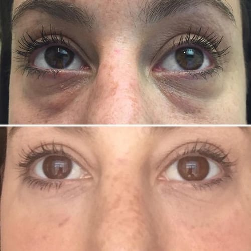 Customer photo review of מדבקות היידרוג'ל קולגן לעיניים