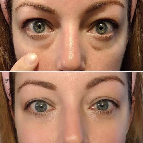 Customer photo review of מדבקות היידרוג'ל קולגן לעיניים