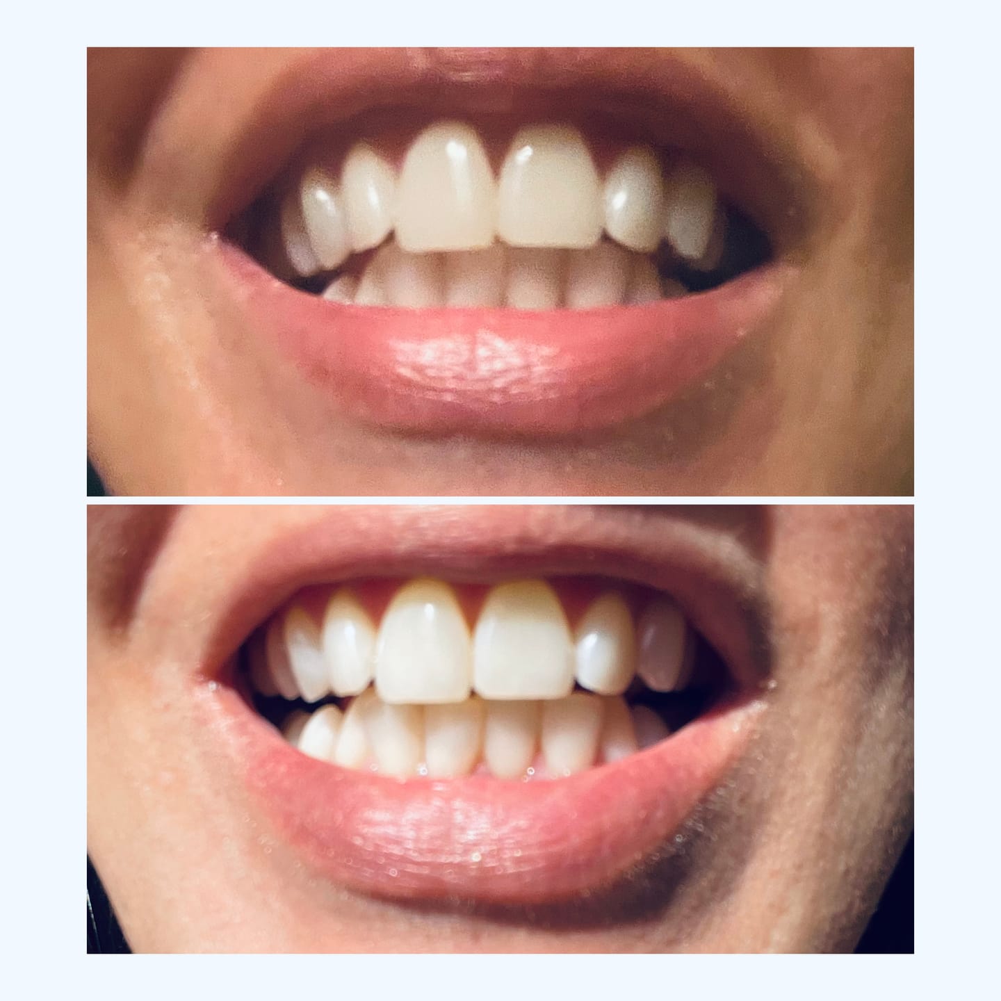 Customer photo review of Teeth Whitening Kit