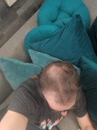 Customer's overhead view of their head, showing thinning hair at the crown while using the rosemary shampoo.