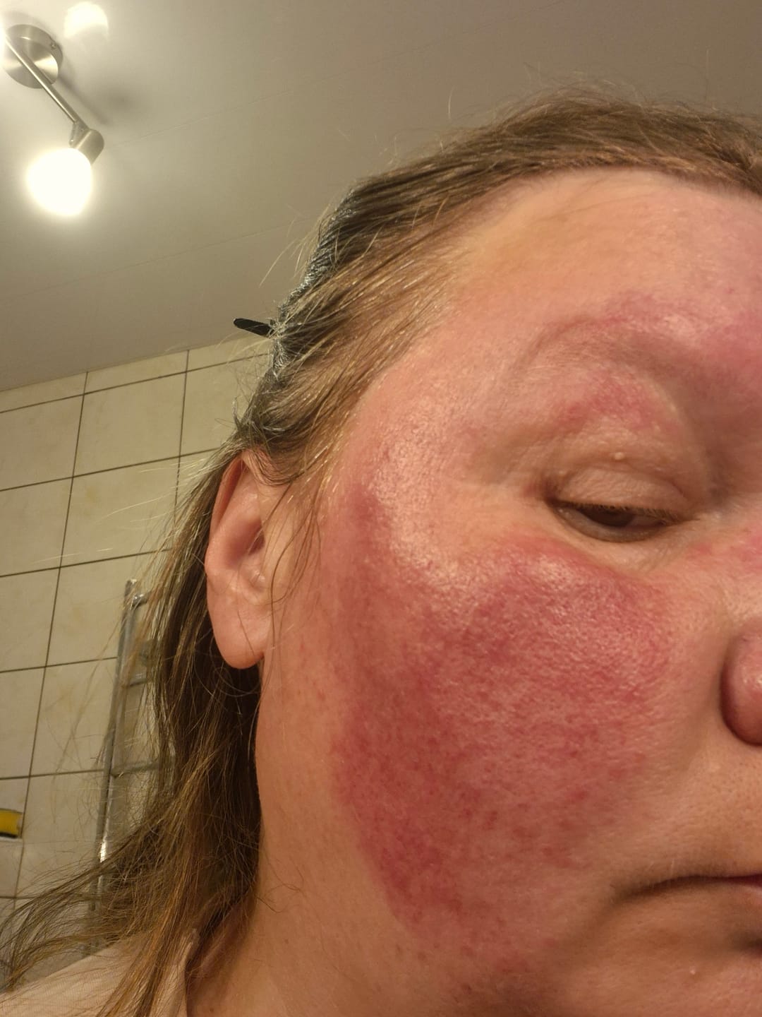 Customer photo review of Azelaino rūgšties kremas nuo raudonio