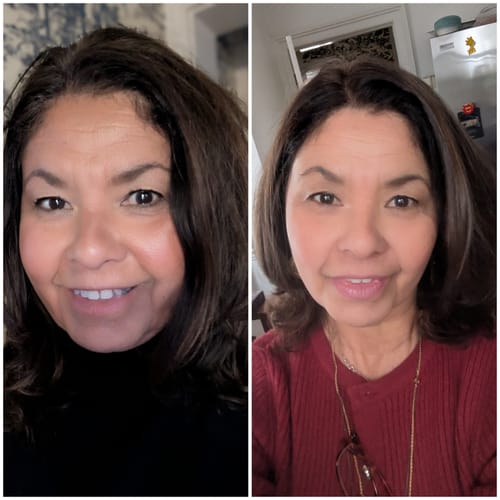 Customer's before-and-after comparison after using The Micro Infusion System, showing visibly smoother and brighter skin.