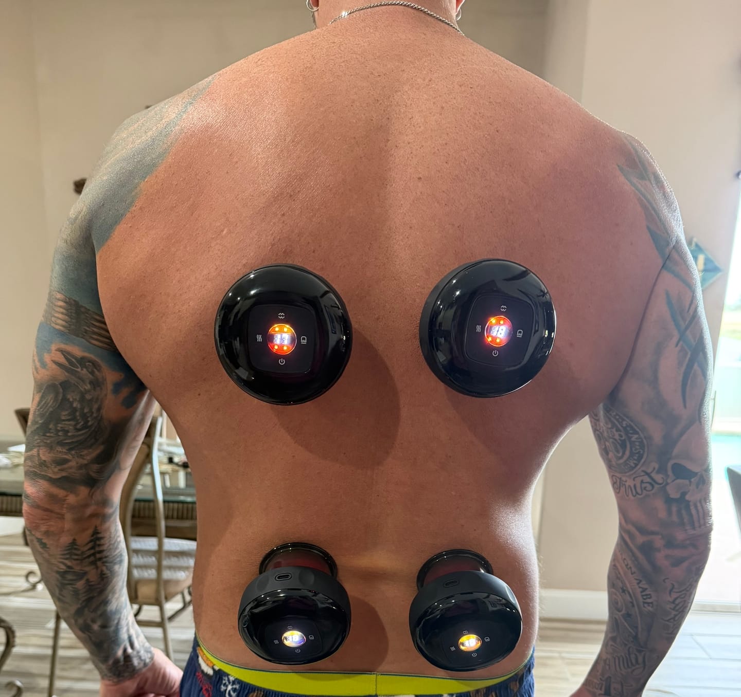 Customer photo review of BRELVO™ Smart Cupping Therapy