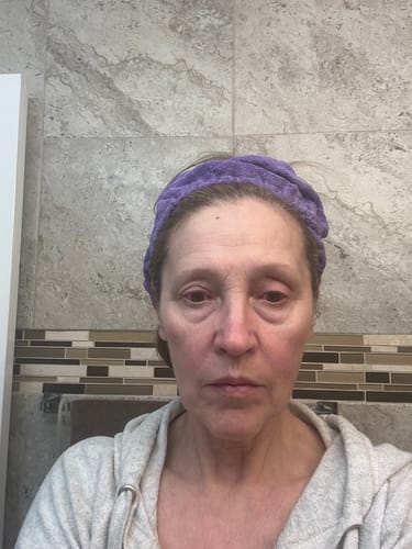Customer showing their face, likely before starting treatments with the Seranova Micro Infusion System.