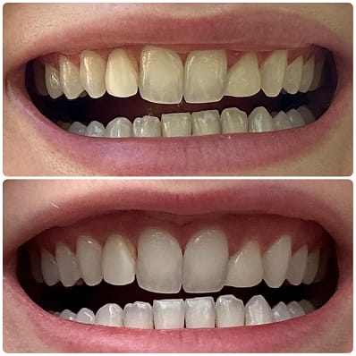 Customer photo review of V34 bieliace pásiky na zuby (14 aplikácií)