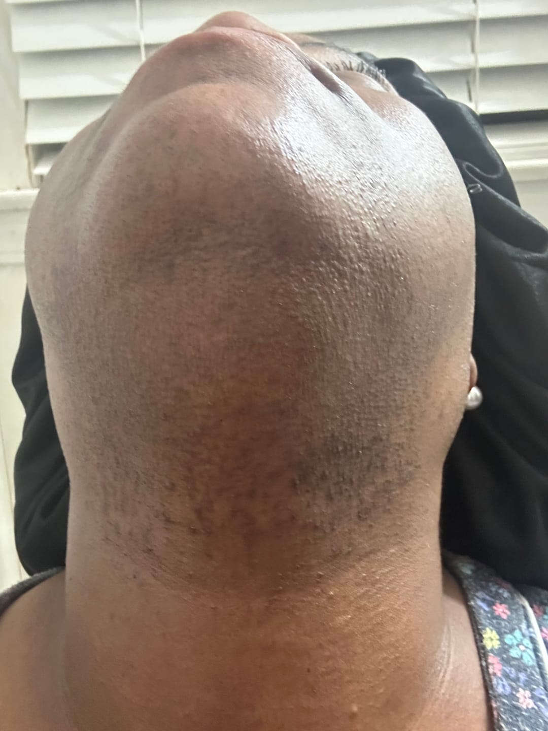 Customer photo review of Hair Reducing Fade Oil - Slows Growth, Thins, and Reduces Hair Naturally