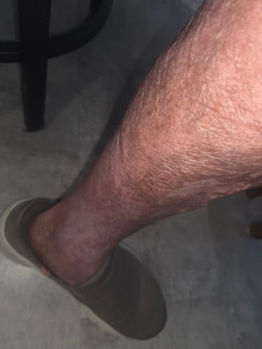Customer photo of lower leg and foot before using the patches