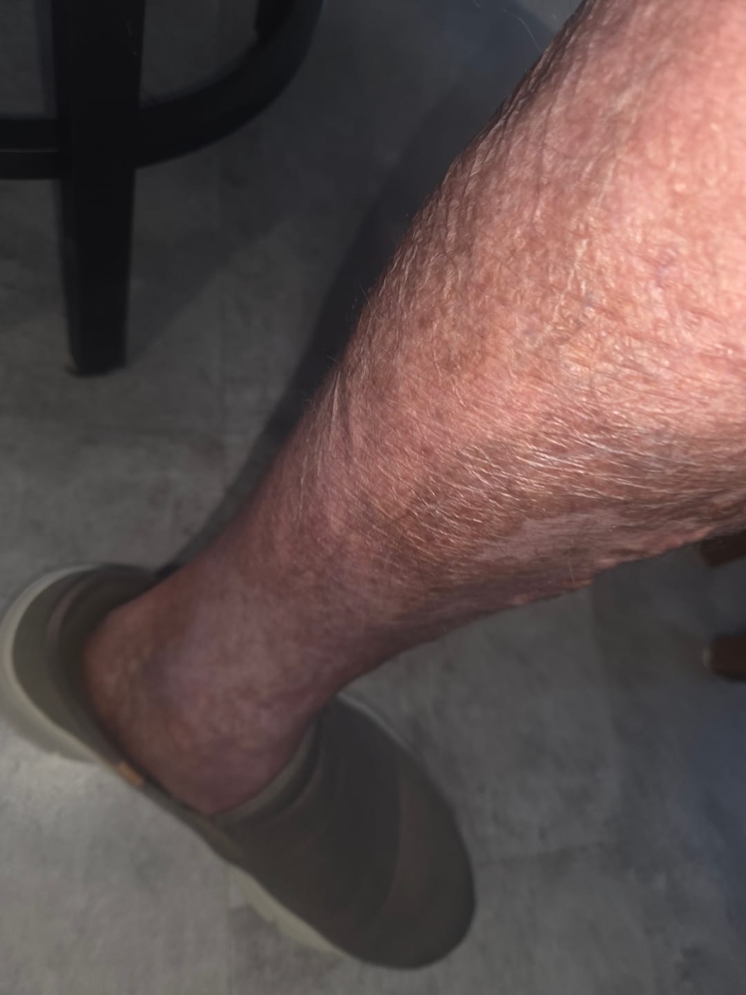 Customer photo review of NerVana+® Nerve Relief Magnesium Patches (60 Patches)
