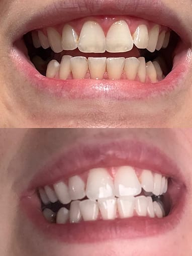Customer photo review of V34 bělicí pásky na zuby