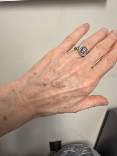 Reviewer's hand showing visible age and sun damage spots that have lightened after using Koriderm™ Time Reverse Cream.