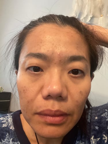Customer photo review of BeautyPro 2.0 - High Frequency Wand