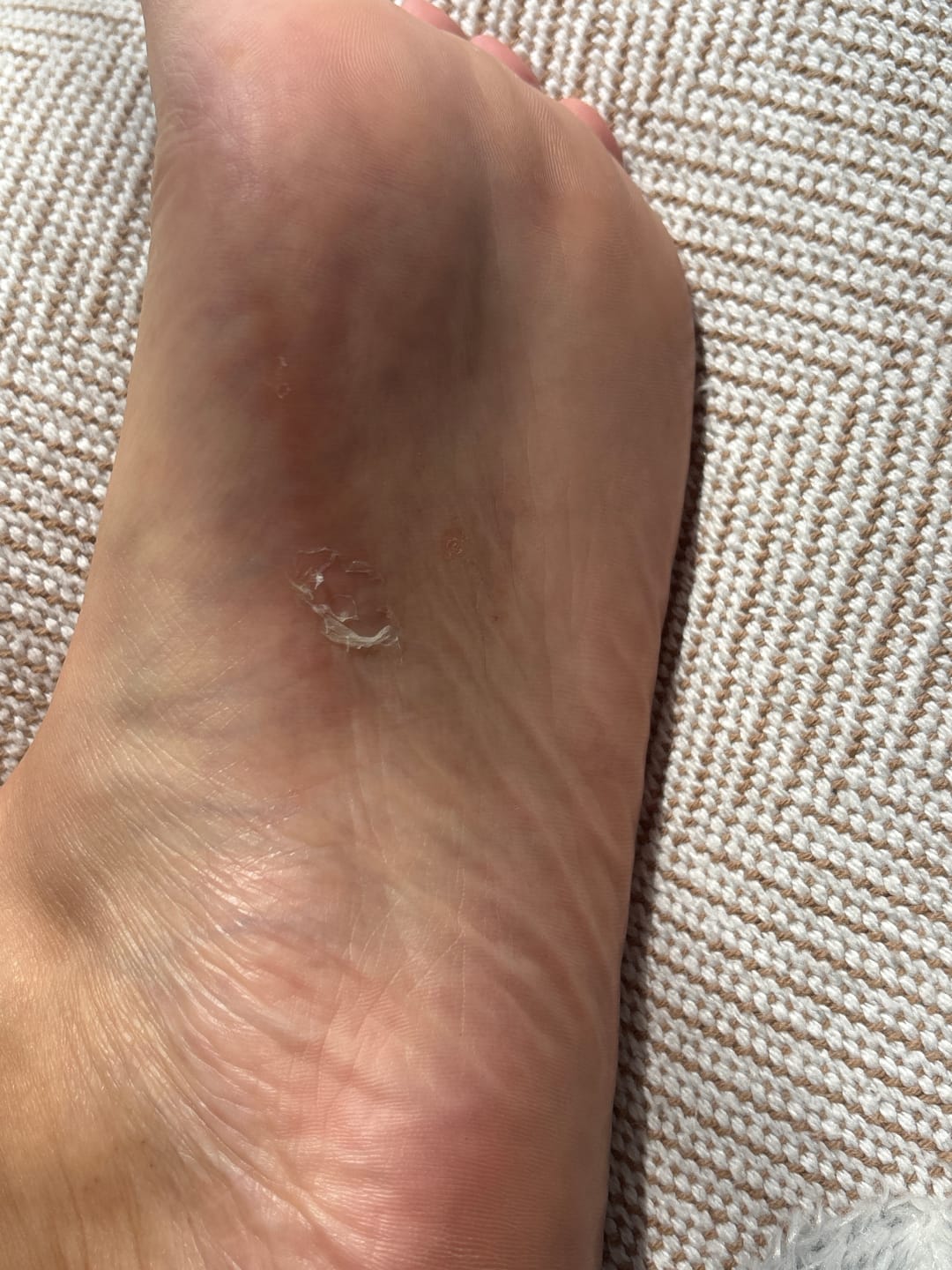 Customer photo review of Baume SOS anti-frottements Invisible - Evite les frottements, les irritations et les ampoules