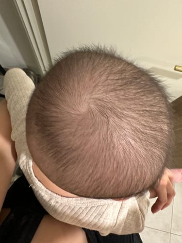 Customer's photo of a baby's clear scalp after using the Cradle Cap Scalp Mask.