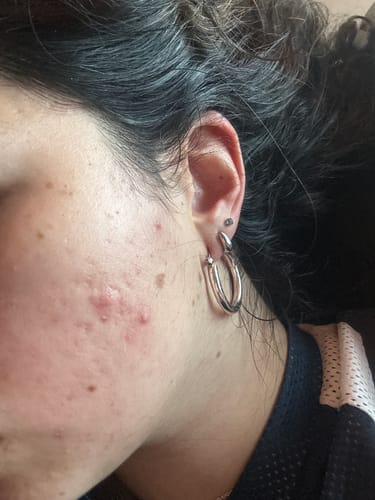 Customer showing their cheek with some active acne and redness while using the Advanced Acne Program™.
