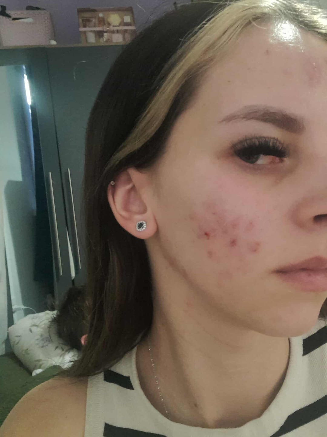 Customer photo review of Pimple Stopper Night Balm