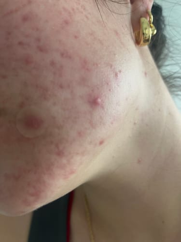 Close-up of a reviewer's cheek and jawline, showing skin with active breakouts and some redness.
