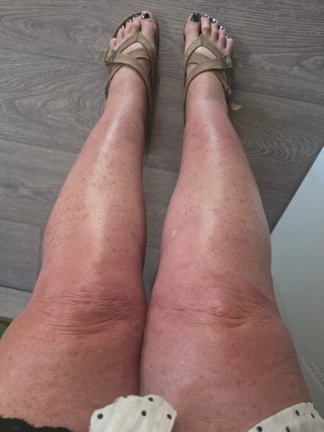 Customer photo review of Dual-Action Lymphatic Gloves