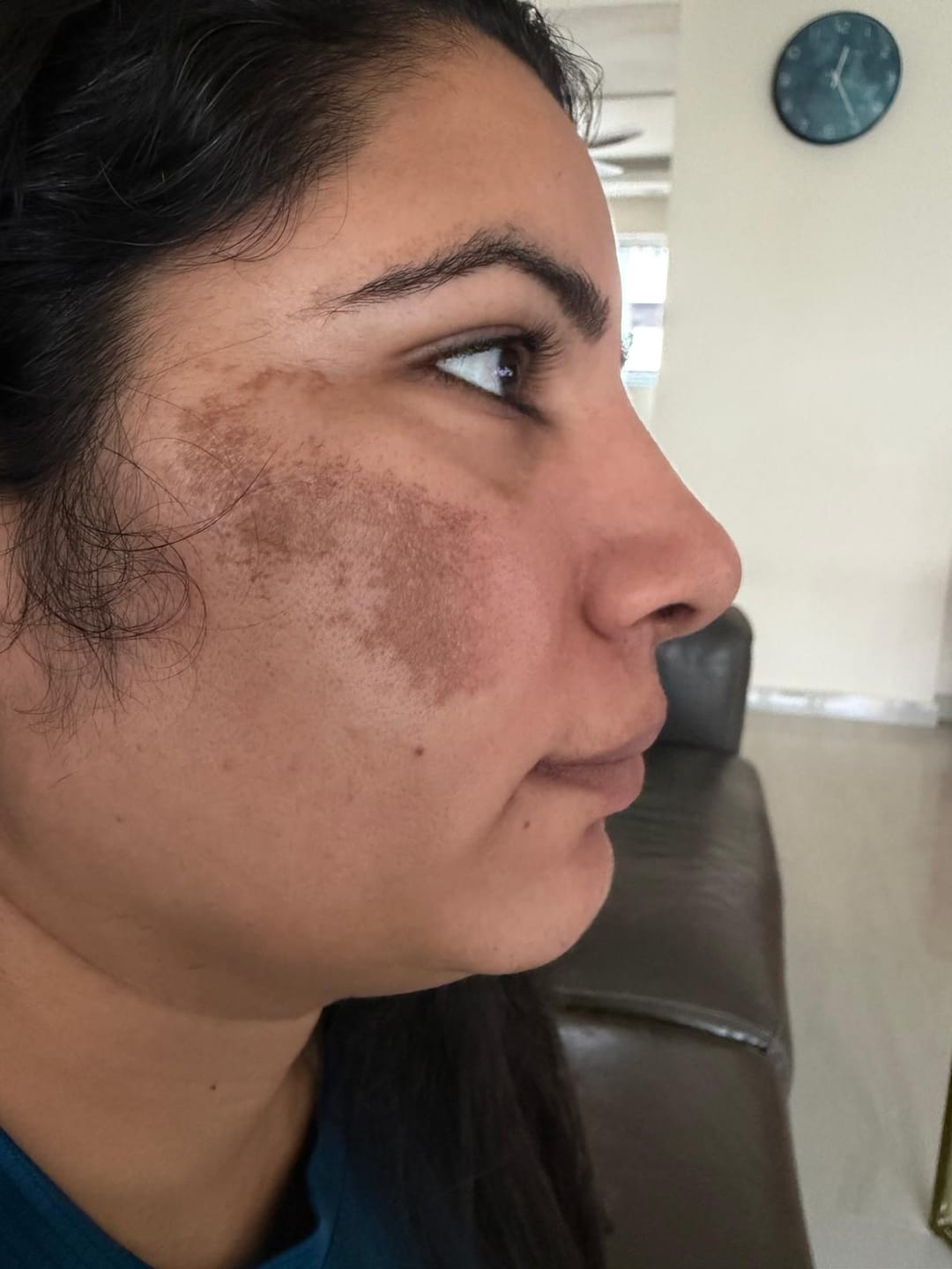 Customer photo review of Ventamin Light Up: Doctor-Formulated Brightening Formula for Melasma, Acne scars & Hyperpigmentation