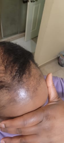 Close-up of a reviewer's scalp showing new baby hairs sprouting at the hairline after using Rennora Hair Growth Serum.