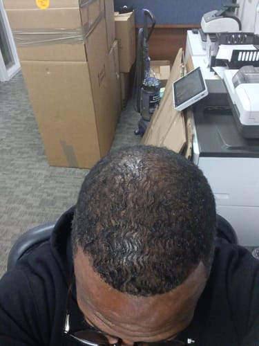 Customer's head from above, showing new hair growth after using Rennora Hair Growth Serum.
