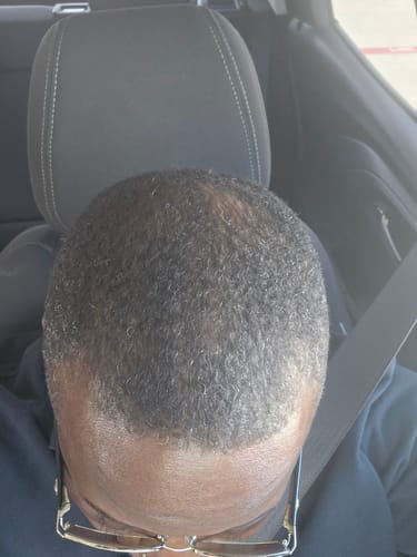 Reviewer showing new hair growth on their scalp after using Rennora Hair Growth Serum in a car.
