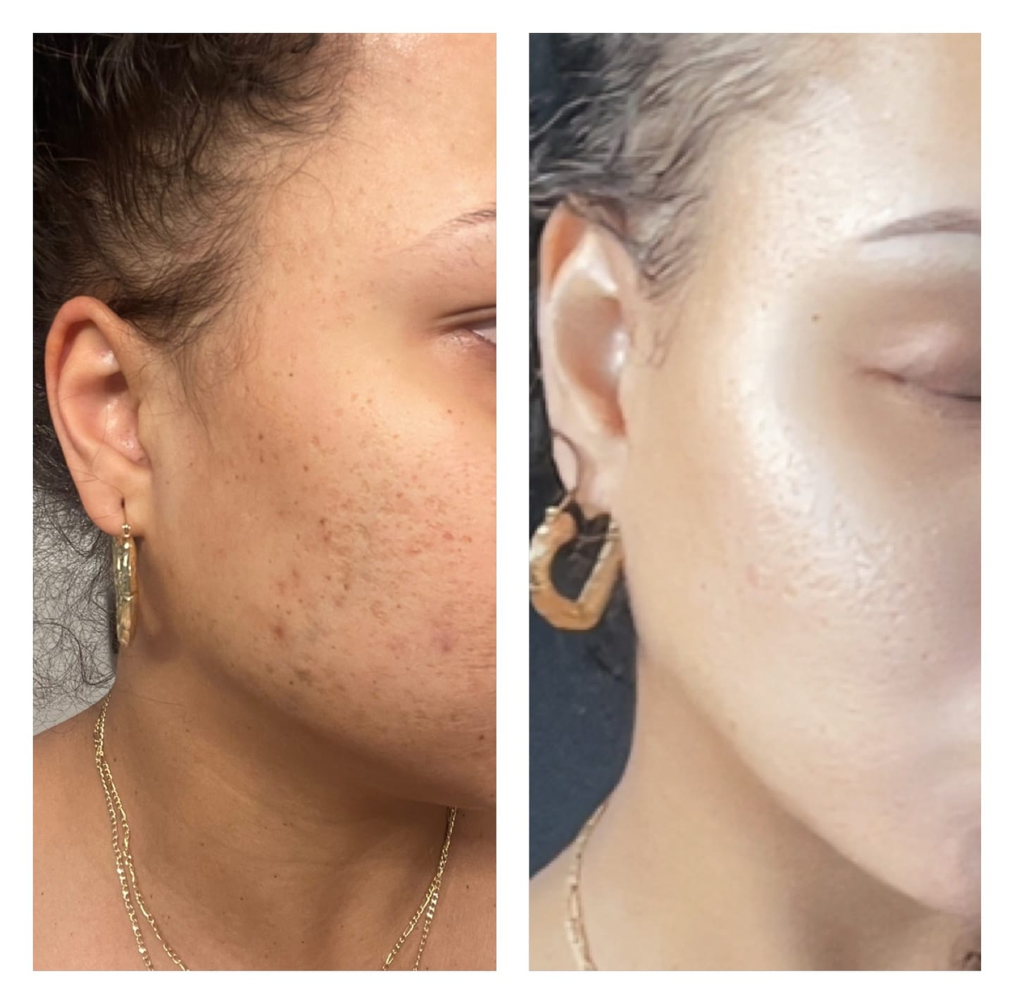 Customer photo review of LIMITED EDITION: Jolie’s Mini Full Body & Face Brightening Kit/ Acne Kit
