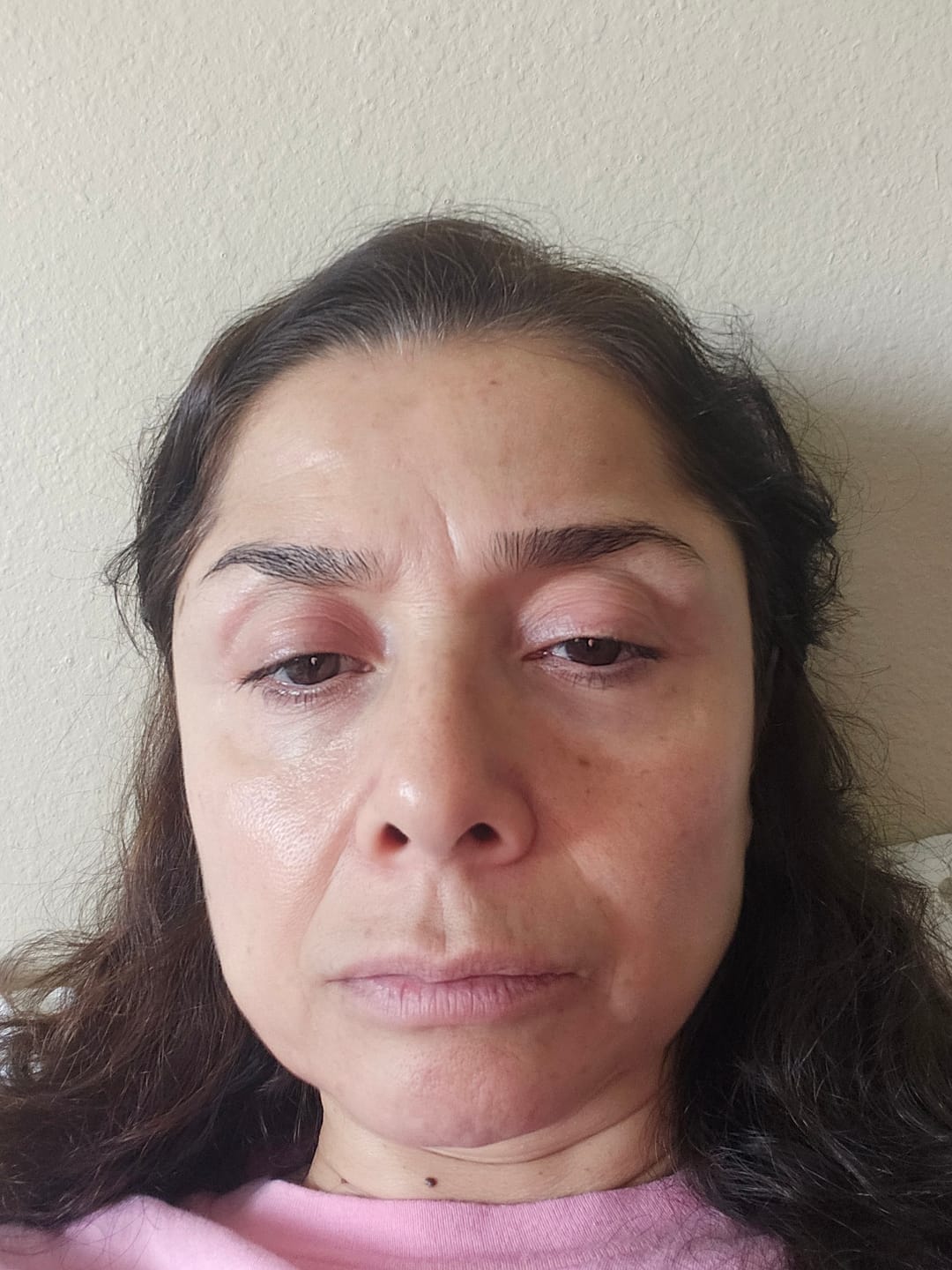 Customer photo review of 2 Month Supply - Micro Infusion Patches