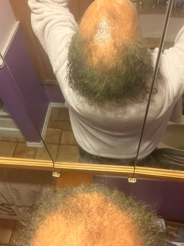 Customer showing the top of their head with significant balding being treated with Rennora Hair Growth Serum.
