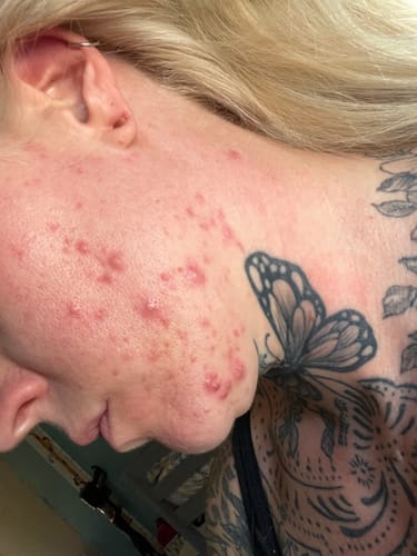 Close-up of a reviewer's cheek with red, inflamed acne before using the 5-Step Clear Skin Kit.