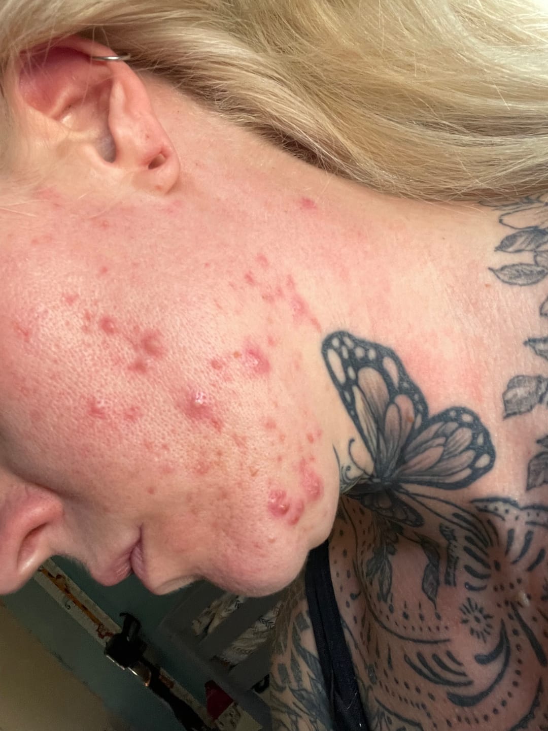 Customer photo review of 5-Step Clear Skin Kit
