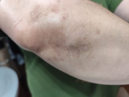 Vásárló karja, amelyen a SERENI krém használatát követően javuló, szinte tünetmentes bőr látható.