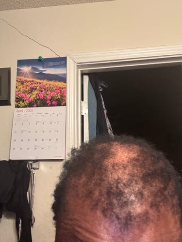 Customer's crown with significant hair thinning before using Rennora Hair Growth Serum.