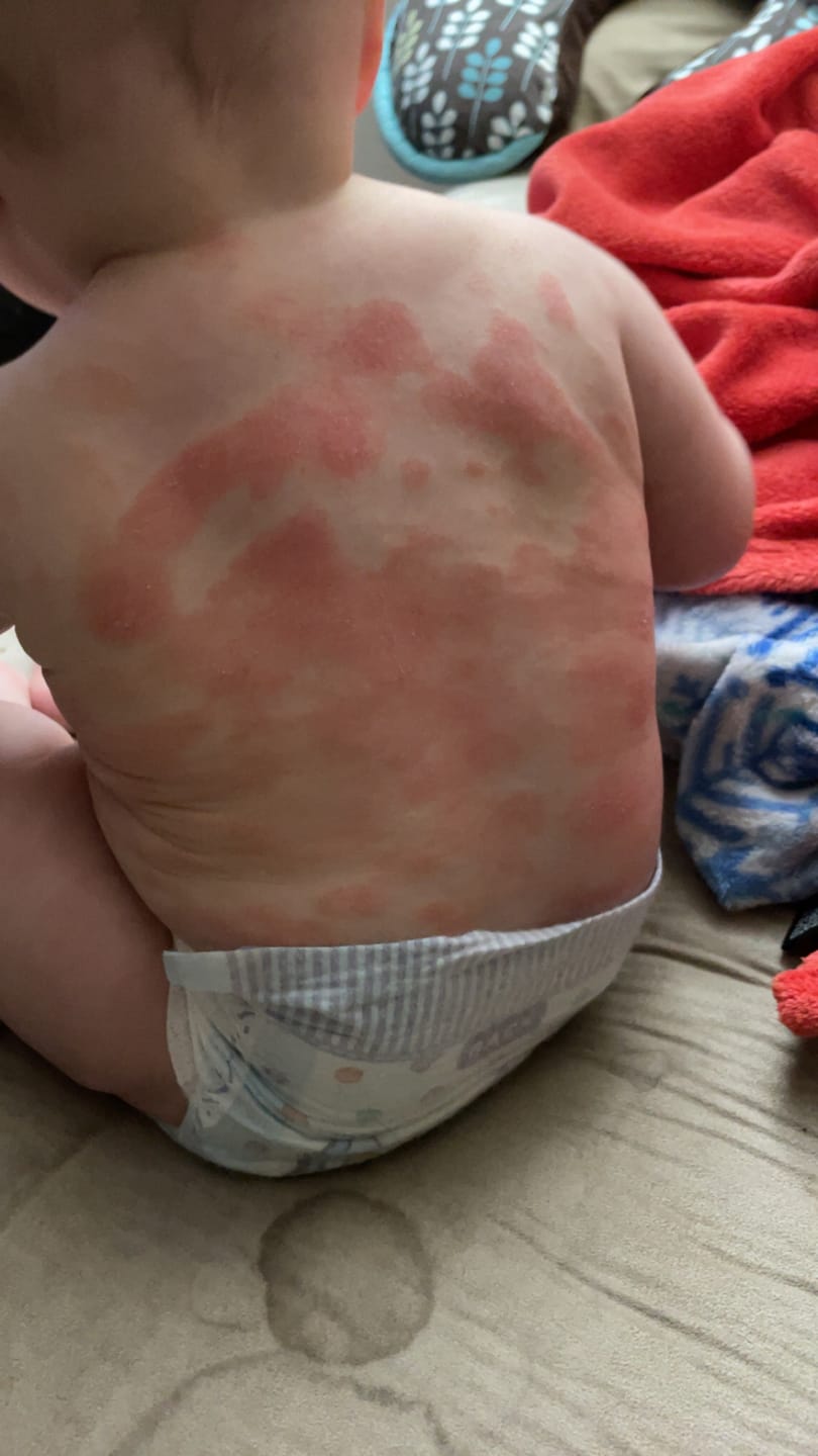 Customer photo review of Beezema Eczema Cream