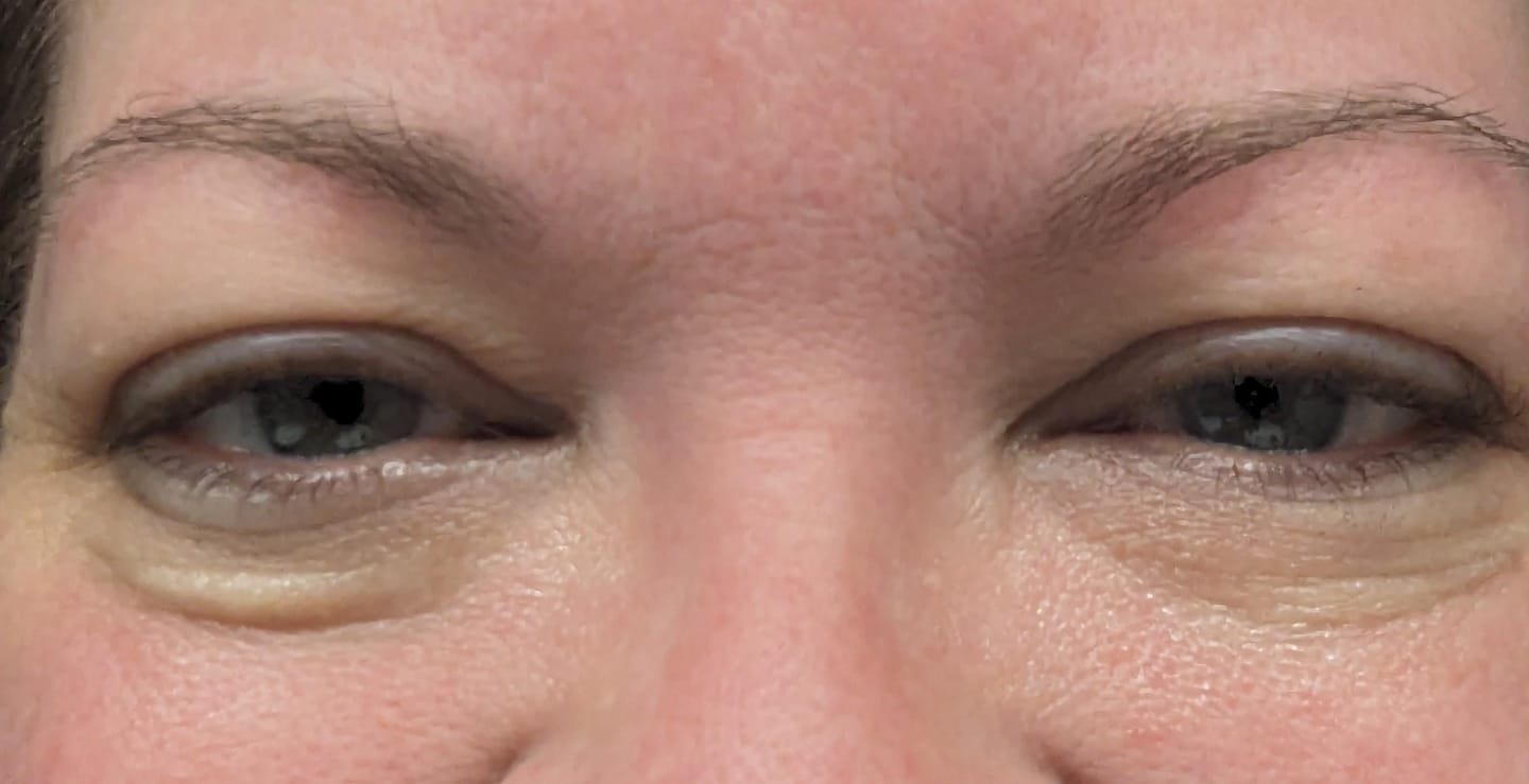 Customer photo review of Natural Botulin Microneedling Patches