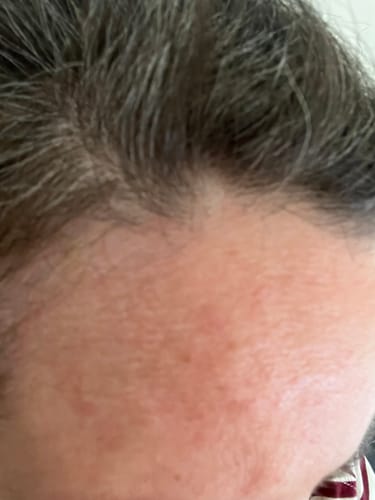 Nahaufnahme der Stirn einer Rezensentin, die nach der Anwendung der Maske rote Pusteln und gereizte Haut zeigt.